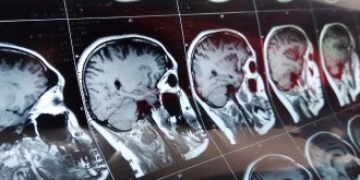 Cavernome cerebral (angiome caverneux) : definition, symptomes, et traitements