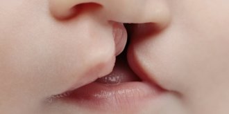 Bec de lievre et fente labio-palatine : definition, causes, prise en charge