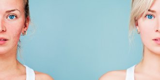 Couperose ou rosacee (nez, visage) : quels causes et traitements (laser, cremes) ?