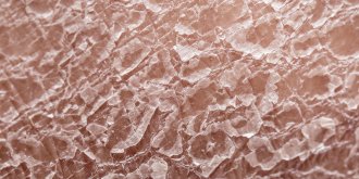 Dermite seborrheique (cuir chevelu, visage…) : quels traitements, causes et symptomes ? 