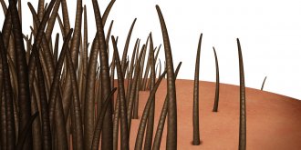 Alopecie (chute de cheveux) : causes, manifestations et traitements