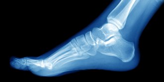 Epine calcaneenne (epine de Lenoir) : douleur au talon, que faire pour la soulager ?