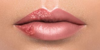 Bouton de fievre : comment soigner un herpes labial (ou buccal) ?