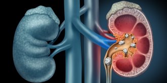 Colique nephretique : symptomes, causes, traitements, que faire en cas de crise