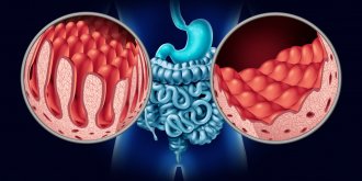  Maladie cœliaque (intolerance au gluten) : symptomes, diagnostic et traitements