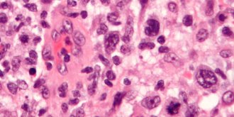 Lymphome : symptomes, traitements du cancer du systeme lymphatique