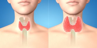 Goitre : definition, causes, symptomes, traitements