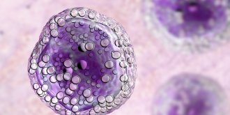 Lymphome de Burkitt : symptomes, diagnostic, traitements, complications