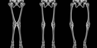 Genu varum : definition, causes, traitements des jambes arquees