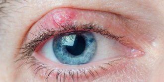 Orgelet : causes, symptomes, traitements pour le soigner, duree