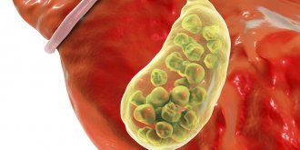  Calculs biliaires (Lithiase vesiculaire) : symptomes, causes, traitements