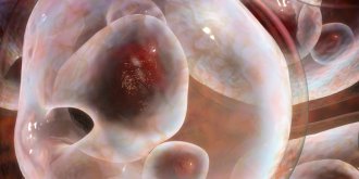 Kyste pilonidal (sacro coccygien) : symptomes, traitements, operation au laser ?