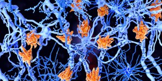 Sclerose en plaques (SEP) : symptomes, traitements, diagnostic, causes