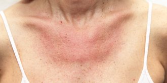 Lucite estivale, polymorphe (allergie au soleil) : symptomes et traitements 