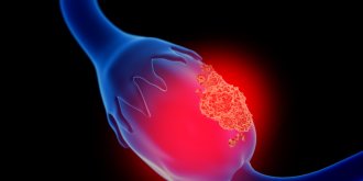  Kyste ovarien : symptomes, causes, traitements, quand operer ? 