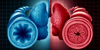 Asthme Allergique : symptomes, traitements, causes