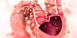 Hernie inguinale : traitements, operation, complications
