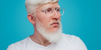 Albinisme : etre albinos, causes, symptomes, transmission
