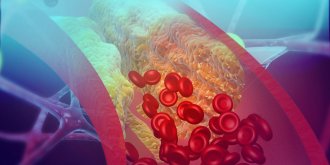 Atherosclerose : symptomes, traitements, consequences, prevention