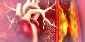 Arteriopathie obliterante (arterite) des membres inferieurs (AOMI) : causes et traitements
