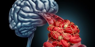 Anevrisme aorte abdominale, cerebral... : symptomes, causes, traitements