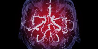 Rupture d’anevrisme : symptomes, causes, quels sont les signes avant-coureurs ?