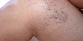 Insuffisance veineuse : symptomes, traitements, causes, risques