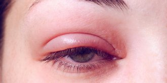 Blepharite : symptomes, causes, traitements
