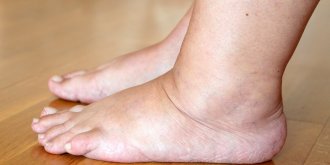 Pieds gonfles : les signes qui doivent vous alarmer