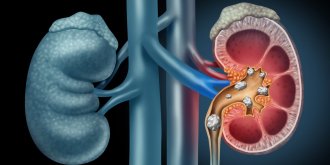 Calculs renaux (lithiase renale) : symptomes, traitements, temps pour evacuer un calcul renal