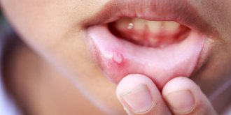 Aphte langue, bouche, gencive, levre… : symptomes, causes et traitements