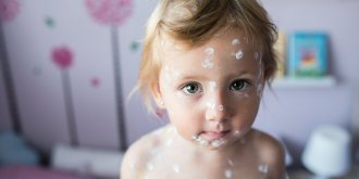 Varicelle : symptomes, contagion, incubation et traitements des boutons