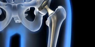 Coxarthrose, arthrose de la hanche : quels symptomes et traitements pour la soigner ?