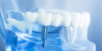 Protheses dentaires : 7 complications possibles si vous en portez
