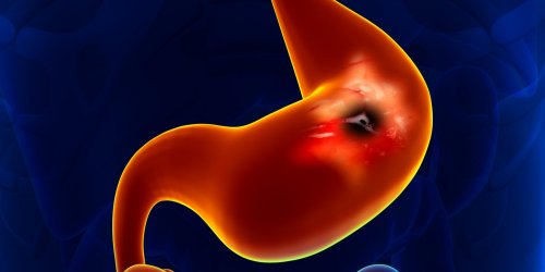 Cancer de l-estomac : symptomes, causes, pronostic, taux de survie