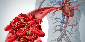 Tachycardie (ventriculaire-supraventriculaire) : definition, causes, traitements