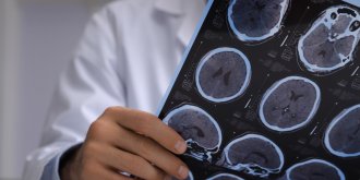 Sclerose en plaques : qui sont les personnes touchees par la maladie ?