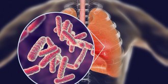 Pneumonie : quels sont ses symptomes, sa contagion, ses causes, ses traitements ?
