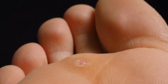 Verrue plantaire : causes, traitements, prevention