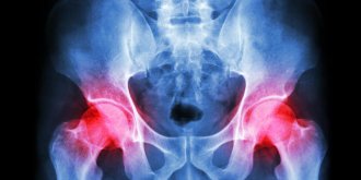 Rhume de hanche chez l-adulte, l-enfant : comment le soigner ?