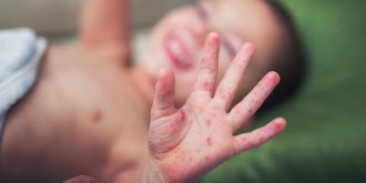 Rougeole : symptomes, contagion, traitements et vaccin