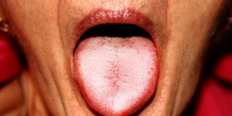 Cancer de la langue : symptomes, pronostic, traitements