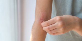 Quiz : connaissez-vous vraiment l’eczema ?