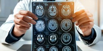 Un implant cerebral permet a une femme de retrouver la parole 18 ans apres un AVC