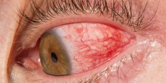 Yeux rouges : un symptome de fatigue visuelle