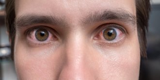 Blanc des yeux rouge : la conjonctivite allergique