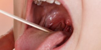 Amygdalite (inflammation des amygdales) : comment la soigner ?