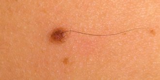 Poils sur un grain de beaute : est-il dangereux de les arracher ?