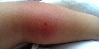 A quoi ressemble une allergie aux piqures de moustiques ?