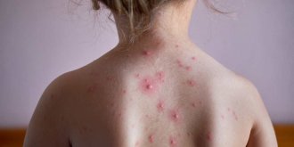 Varicelle ou rougeole : comment faire la difference ?